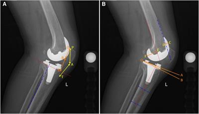 3D-printed patient-specific instrumentation decreases the variability of patellar height in total knee arthroplasty